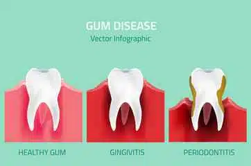 How do you get rid of gum disease at home