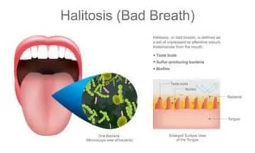 Halitosis (Bad breath): Why do Saliva and Tongue Smells Badly?