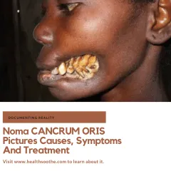 Noma CANCRUM ORIS Pictures: Causes, Symptoms And Treatment