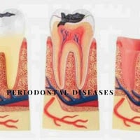 Periodontal-Disease