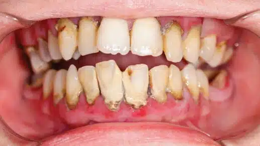 Periodontal-Disease