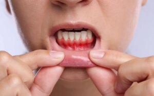 Home remedies for receding gums
