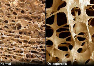 Osteoporosis of the jaw Osteoporosis and dental health
