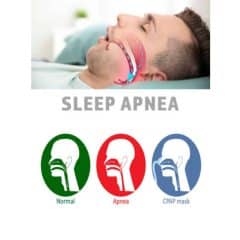 sleep apnea