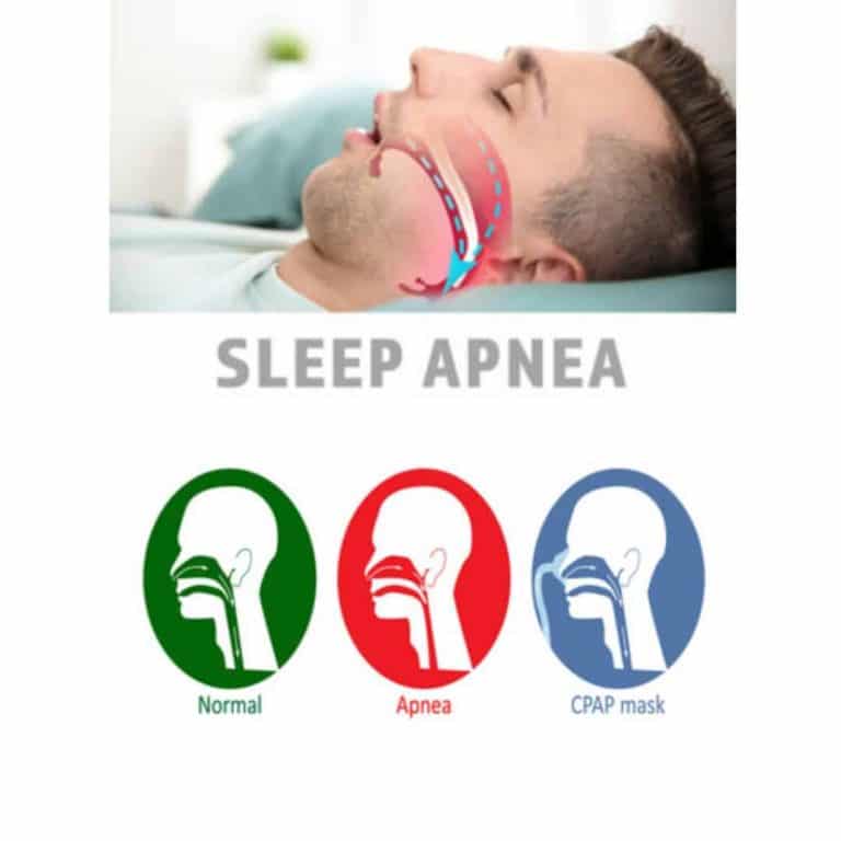 sleep apnea