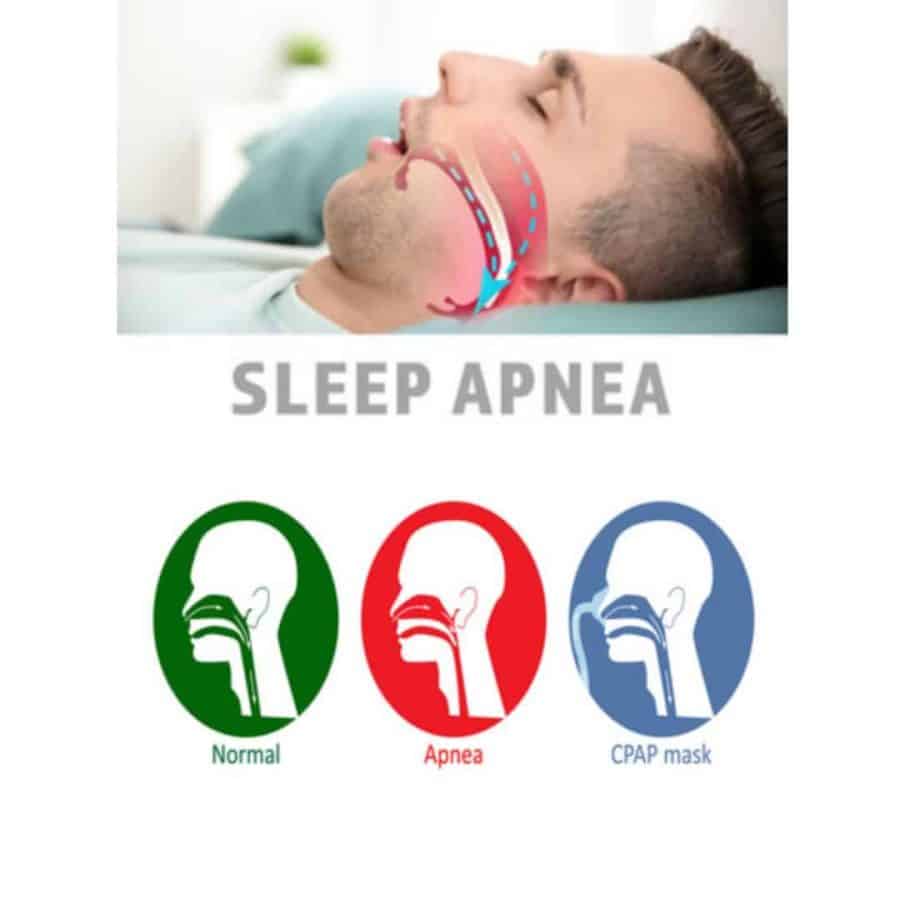 Sleep Apnea