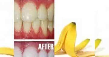 Banana peel for teeth: 6 proven ways to whitening teeth with banana peel