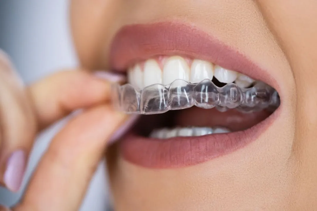 890636c4 ddba 47fe b449 a31b49d05fd2 Clear Aligners W6SVhByTK