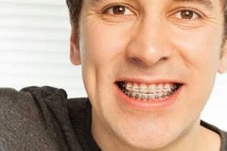 How Traditional Metal Braces Measure Up To The Clear Dental Aligner Braces