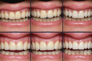 4 Step by step guide to teeth flossing