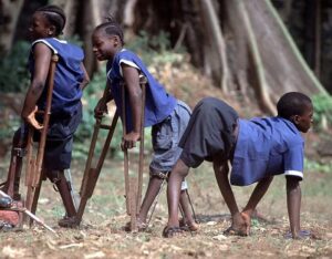 Poliomyelitis