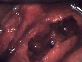 Everything you need to Know About Osteonecrosis of the Jaw