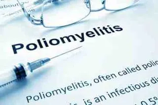 Poliomyelitis (Polio) - Symptoms, Treatment, And Prevention