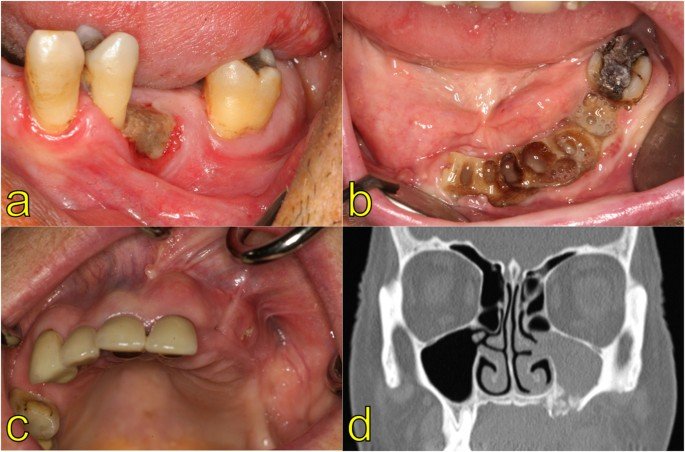 Everything you need to Know About Osteonecrosis of the Jaw