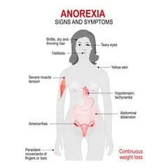 Anorexia Nervosa: Causes, Symptoms And Treatments