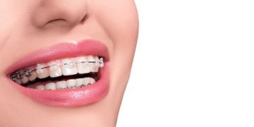 What You Need to Know About Malocclusion and How to Treat It