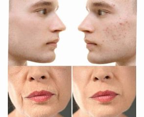 Tretinoin Supatret Gel-Get Rid Of Acne And Wrinkles