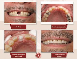 BONE GRAFTING: USES, TYPES, AND PROCEDURE