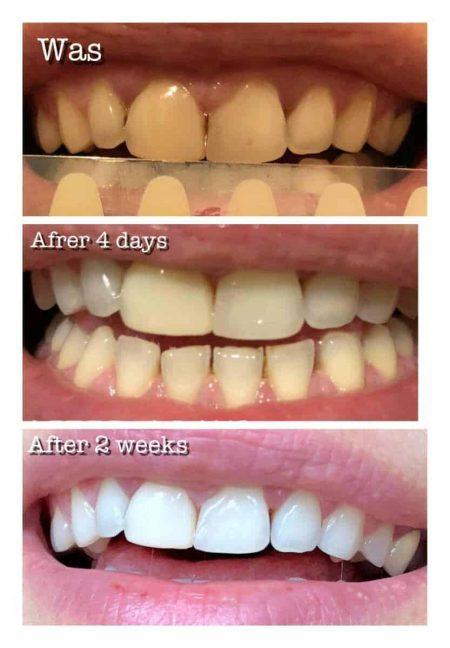Is Teeth Whitening Safe For Enamel?
