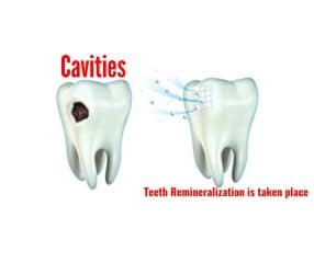 teeth remineralization