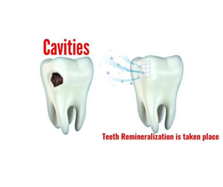 teeth remineralization