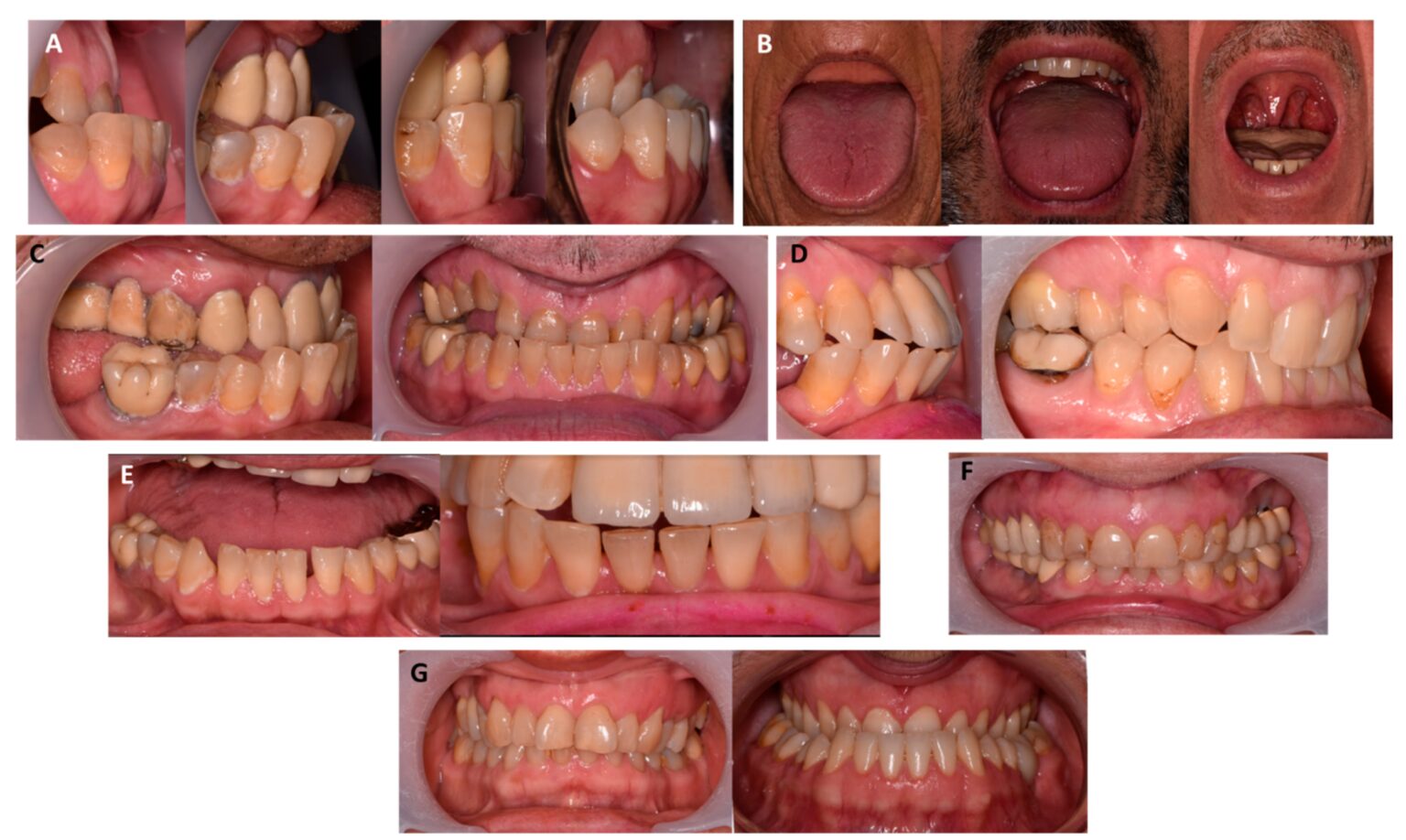 Oral Symptoms That Point Out Growth Hormone Disorders