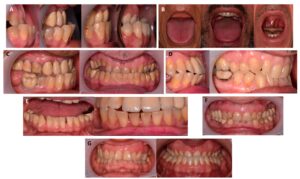 Oral Symptoms That Point Out Growth Hormone Disorders