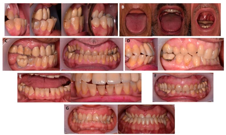 Oral Symptoms That Point Out Growth Hormone Disorders