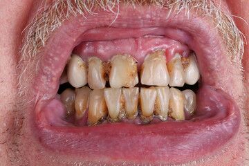 alcohol and oral health