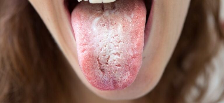 oral thrush