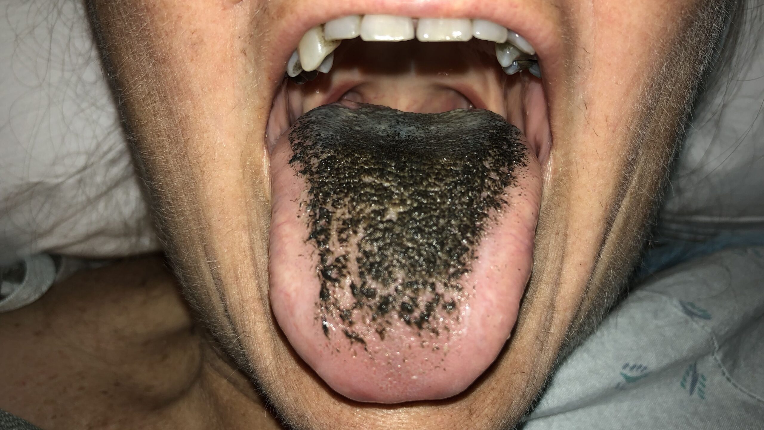 black hairy tongue