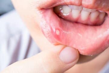 canker sores