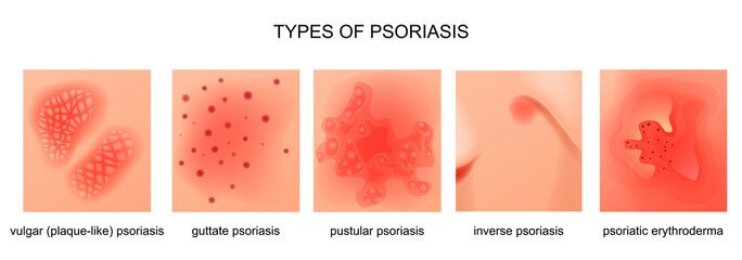 psoriasis