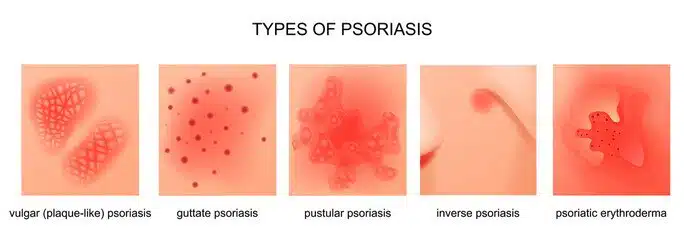 Psoriasis