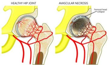 Avascular necrosis