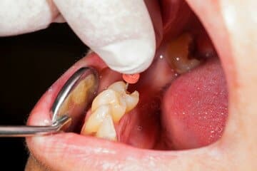Endodontic Surgery: Root Canal And Apicoectomy Explained