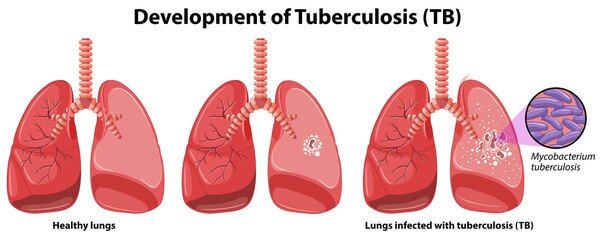 tuberculosis