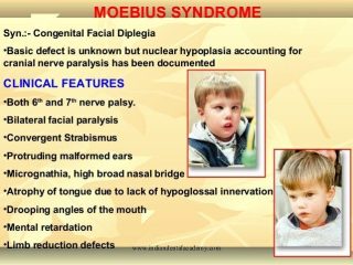 Moebius syndrome