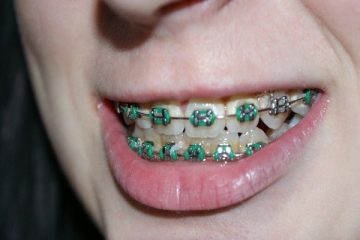 9 Major foods to avoid if you have dental braces on!