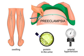 Preeclampsia: Causes, Symptoms, Diagnosis and Treatment