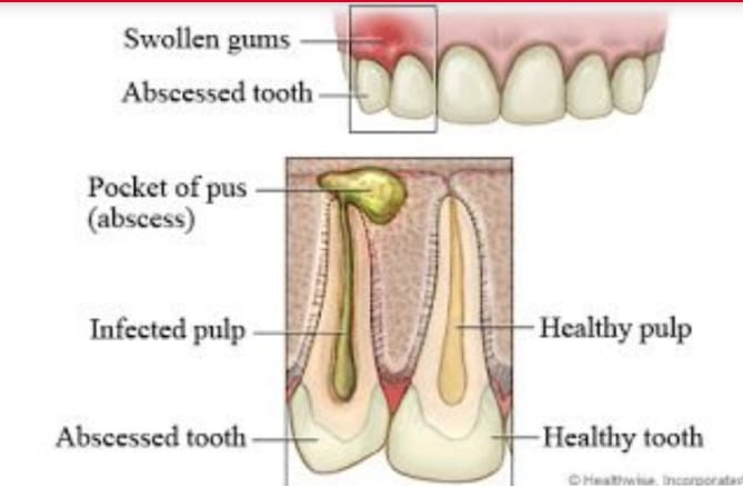 abscessed tooth can suffer from dental problems as well.