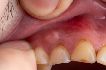 antibiotic for an infected tooth
