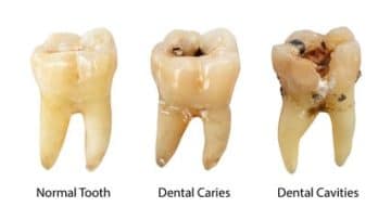 antibiotic for an infected tooth