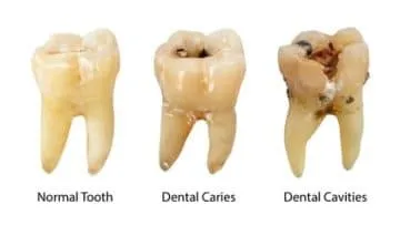 antibiotic for an infected tooth