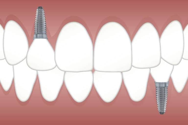 Dental Implants After Care Tips.jpg