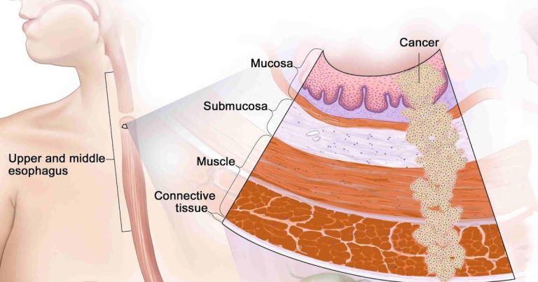 The basic guide: Esophageal Cancer