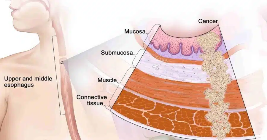 The Basic Guide: Esophageal Cancer