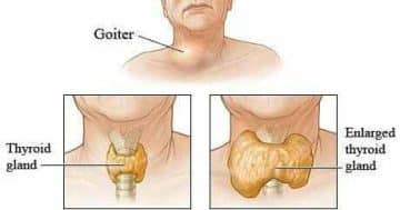 Goiter: Causes, Symptoms, Treatment And Prevention