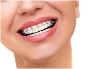 How Straight Teeth Can Promote Better Oral Health