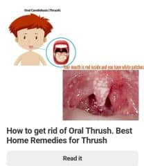 oral thrush